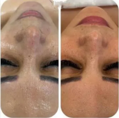 لیزر موهای زائد در بروجرد