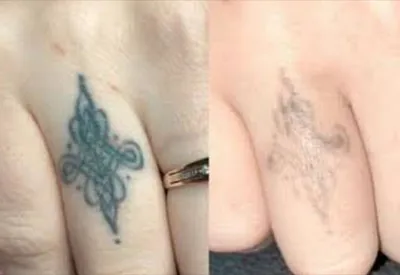 مرکز لیزر در بروجرد