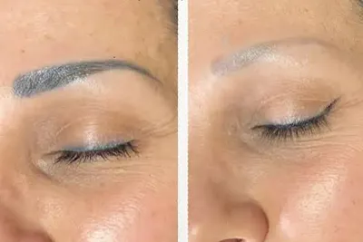 لیزر تتو در بروجرد