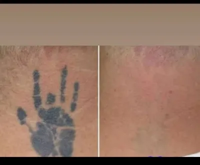 لیزر تتو در بروجرد