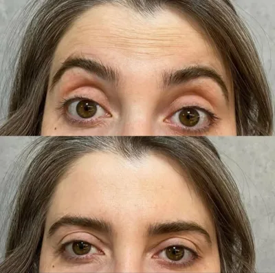 تزریق ژل و بوتاکس در اصفهان