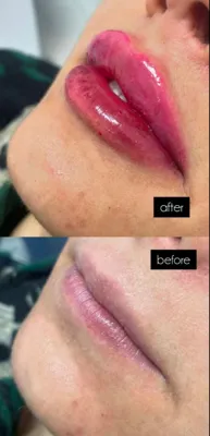 تزریق ژل و بوتاکس در اصفهان