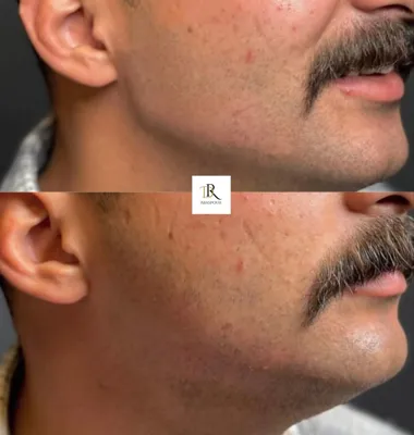 تزریق ژل و بوتاکس در اصفهان