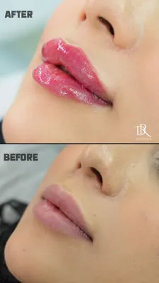 تزریق ژل و بوتاکس در اصفهان