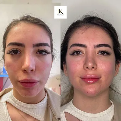 تزریق ژل و بوتاکس در اصفهان