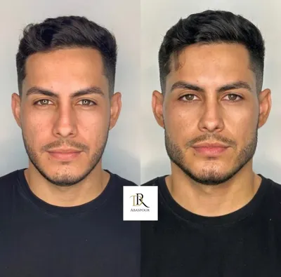 تزریق ژل و بوتاکس در اصفهان