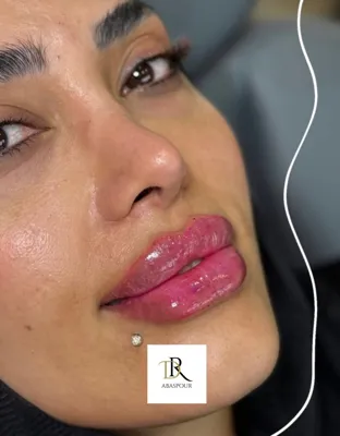 تزریق ژل و بوتاکس در اصفهان