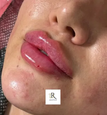 تزریق ژل و بوتاکس در اصفهان
