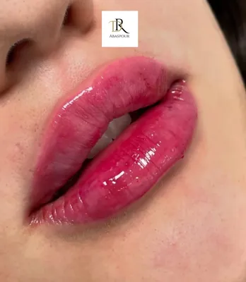 تزریق ژل و بوتاکس در اصفهان