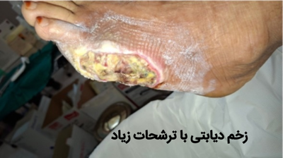 درمان تخصصی زخم در آمل