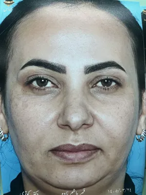 انواع جراحی بینی در اصفهان
