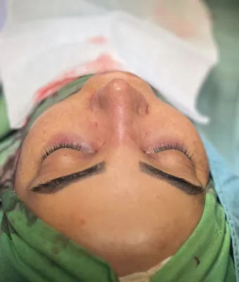 جراحی زیبایی بینی&nbsp;اصفهان