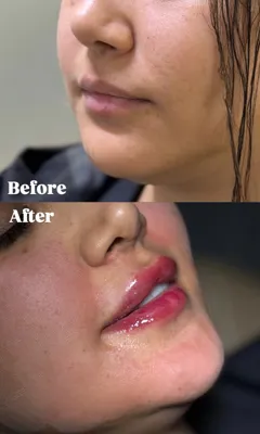 تزریق ژل لب در فردیس