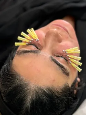 رفع تیرگی صورت در کرج