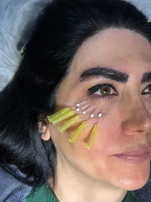 رفع تیرگی زیر چشم در فردیس