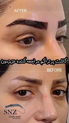 بهترین کاشت ابرو شیراز