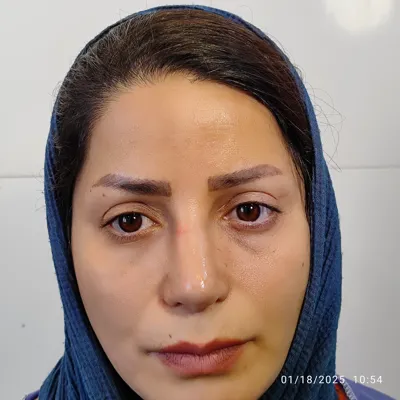 بهترین کاشت ابرو در شیراز