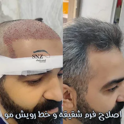 کاشت ریش شیراز ساناز شهوند