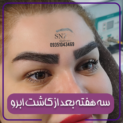 کاشت ابرو در شیراز