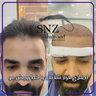 کاشت ابرو در شیراز