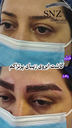 کاشت مو اقساطی در اصفهان