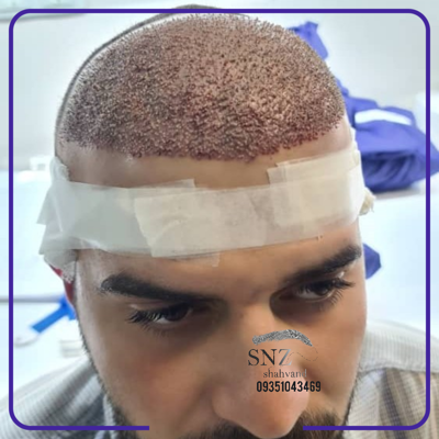 کاشت ابرو و مو اصفهان