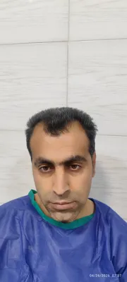 قیمت کاشت ابرو اصفهان
