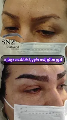 کاشت ابرو و مو اصفهان