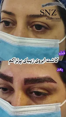 کاشت مو اقساطی اصفهان