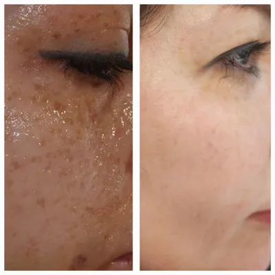 پاکسازی لک بر صورت