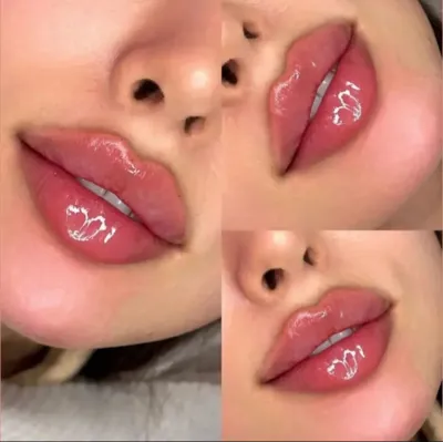 تزریق ژل به سلیقه خودتون