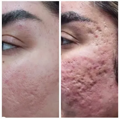 از بین بردن جوش روی صورت