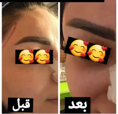 لیفت ابرو