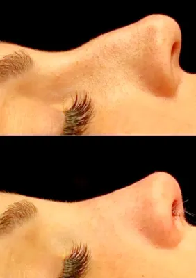 دکتربابایی متخصص عمل بینی گوشتی در اصفهان