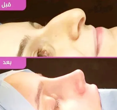 دکتربابایی متخصص عمل بینی گوشتی در اصفهان