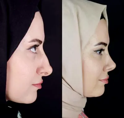 دکتربابایی متخصص عمل بینی گوشتی در اصفهان