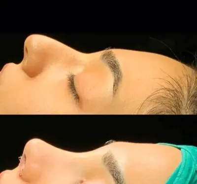 دکتربابایی متخصص عمل بینی گوشتی در اصفهان