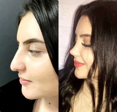 دکتربابایی متخصص عمل بینی گوشتی در اصفهان
