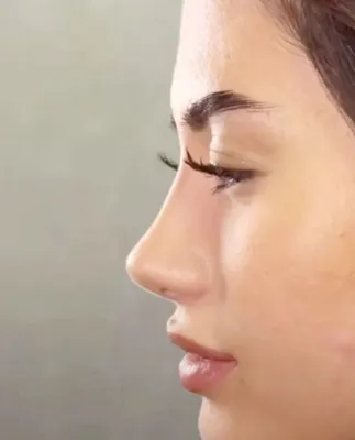 دکتربابایی متخصص عمل بینی گوشتی در اصفهان
