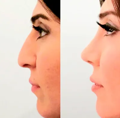 دکتربابایی متخصص عمل بینی گوشتی در اصفهان