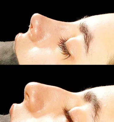 دکتربابایی متخصص عمل بینی گوشتی در اصفهان