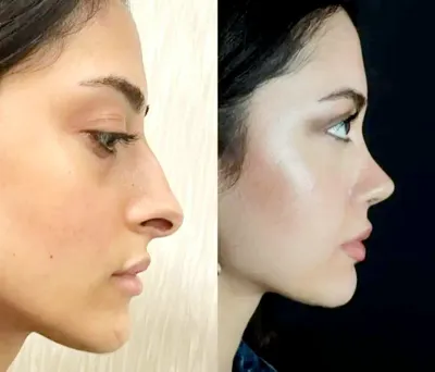 دکتربابایی متخصص عمل بینی گوشتی در اصفهان
