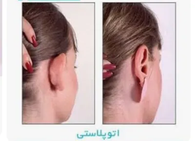 دکتر عمل بینی استخوانی دراصفهان