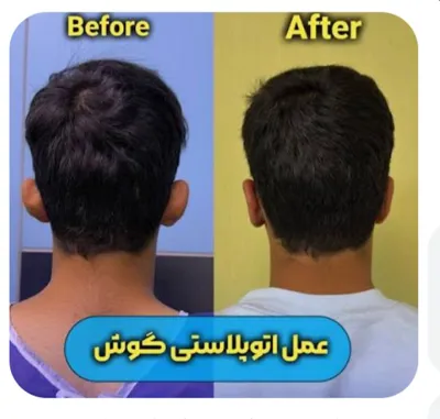 دکتر عمل بینی استخوانی دراصفهان