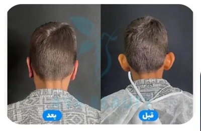 دکتر عمل بینی استخوانی دراصفهان