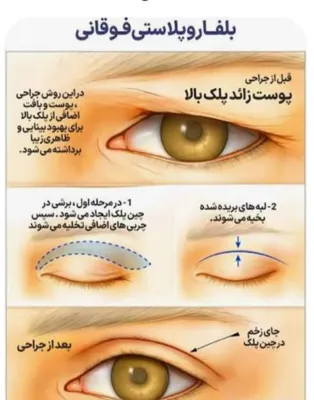 دکتر عمل بینی استخوانی دراصفهان