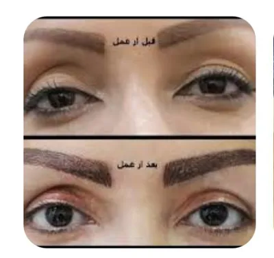 دکتر عمل بینی استخوانی دراصفهان