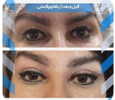 دکتر عمل بینی استخوانی دراصفهان