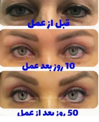 دکتر عمل بینی استخوانی دراصفهان