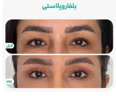 دکتر عمل بینی استخوانی دراصفهان